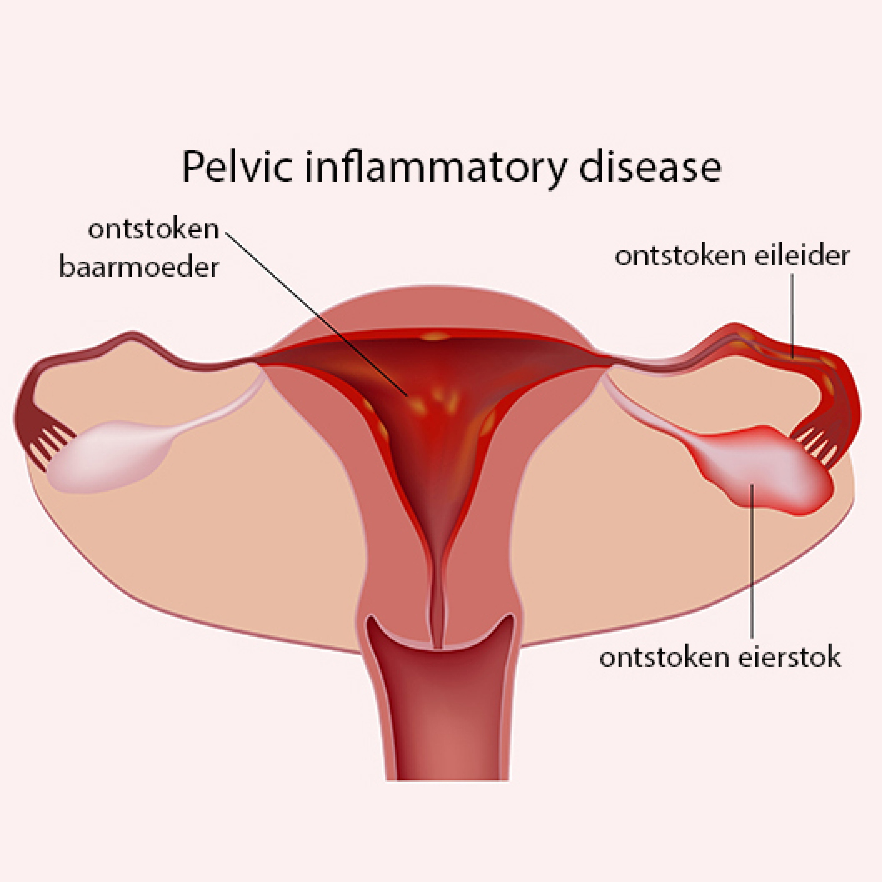 NHG-Standaard Pelvic inflammatory disease herzien episode artwork