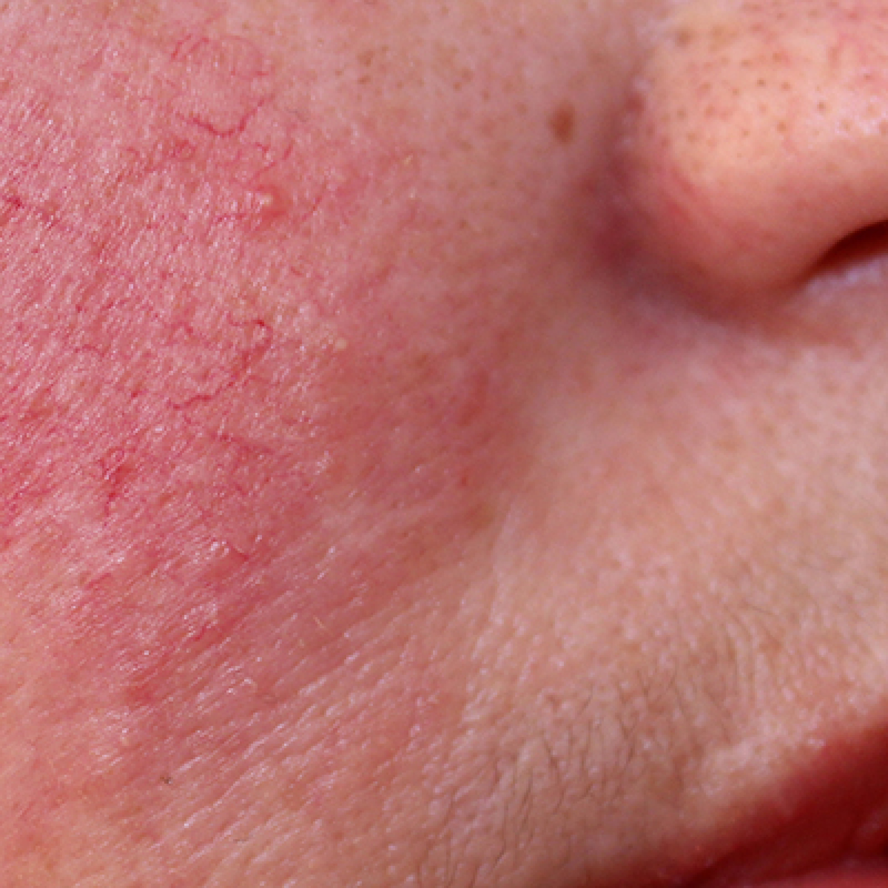 Herziene NHG-Behandelrichtlijn Rosacea episode artwork